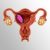 Uterine Cancer
